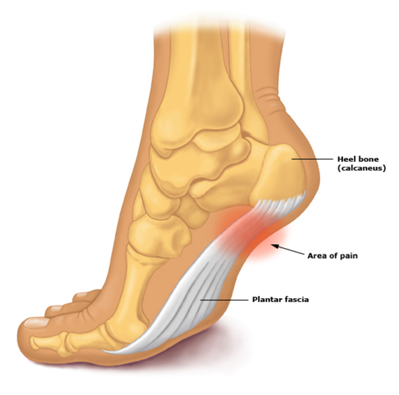 Plantar Fasciitis