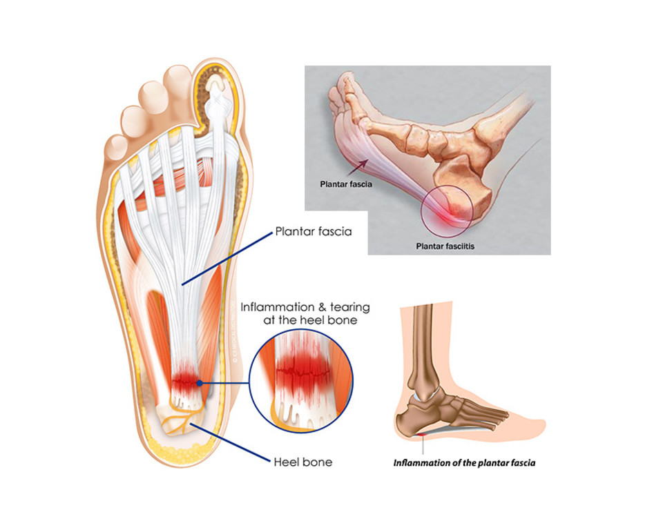 Plantar Fasciitis