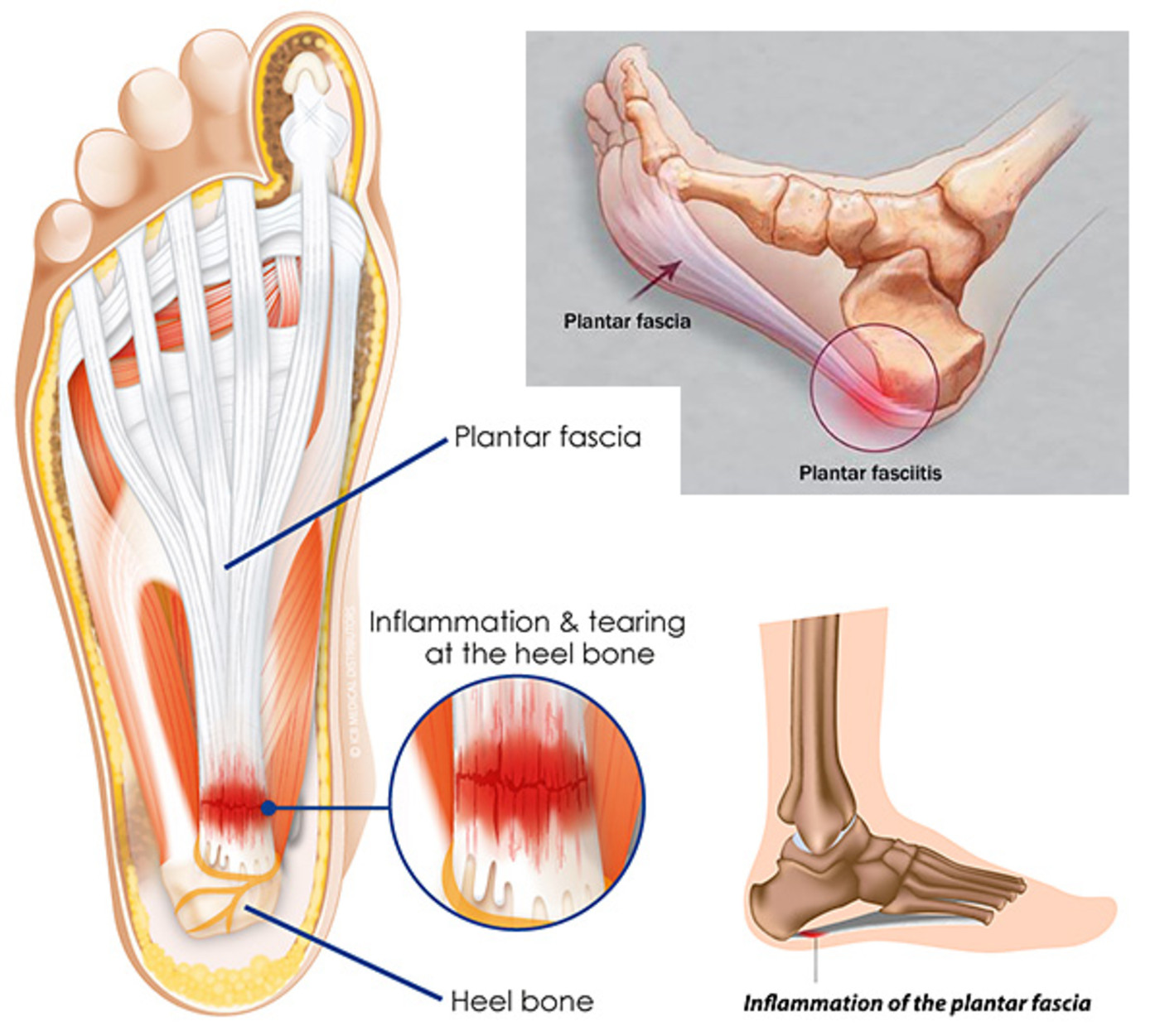 Plantar Fasciitis