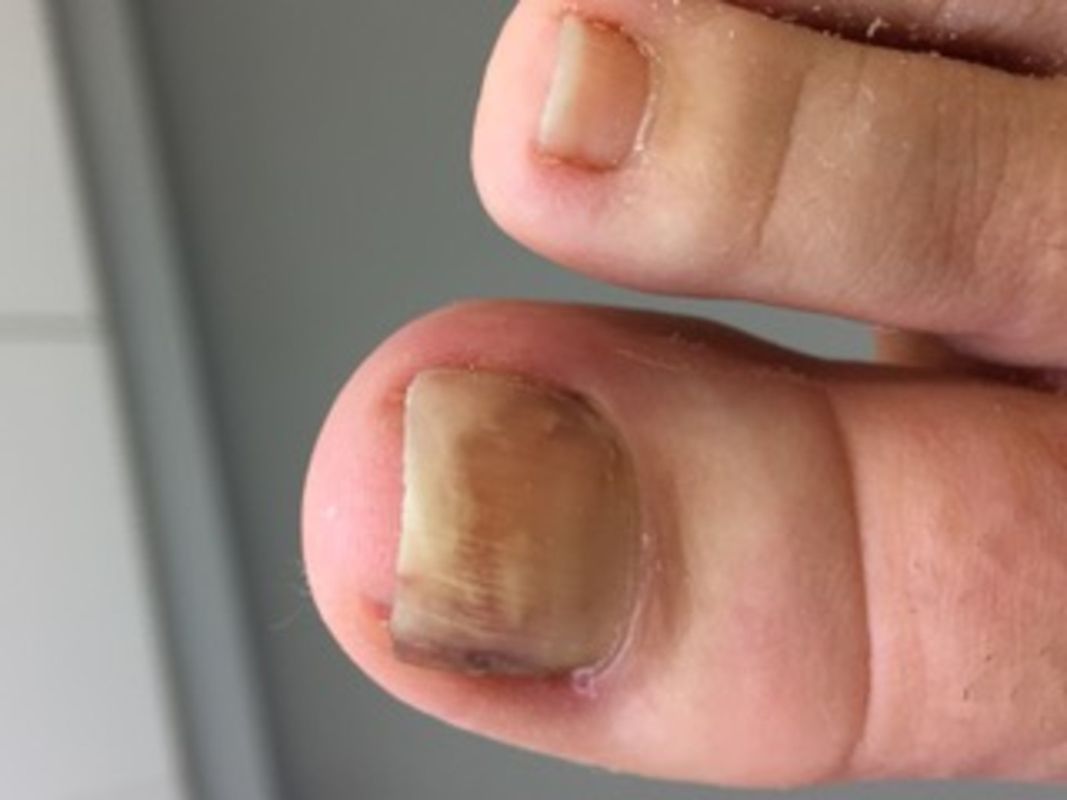 Ingrowing Toenail Before Arkada Treatment